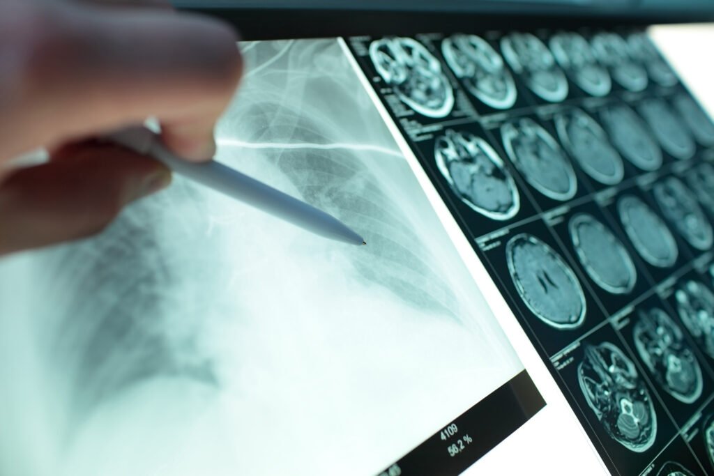 cáncer de pulmón: radiografía de pulmones observada en un negatoscopio