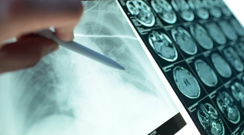 cáncer de pulmón: radiografía de pulmones observada en un negatoscopio