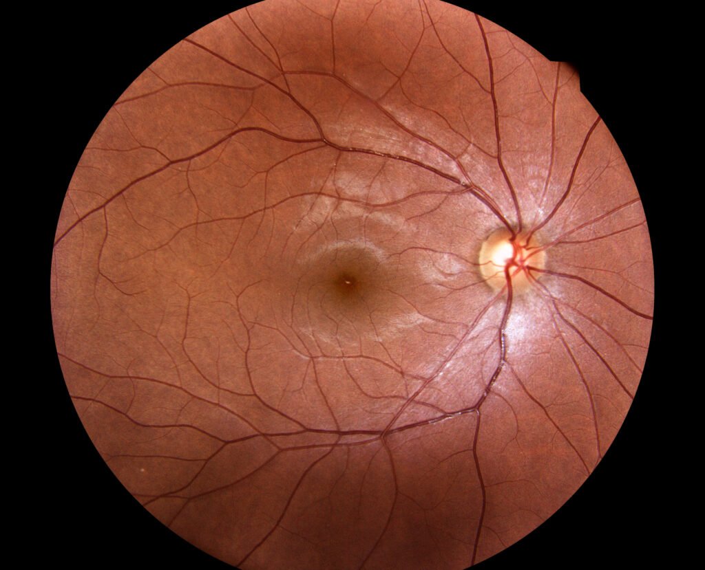 inteligencia artificial y diabetes: imagen médica de una retina
