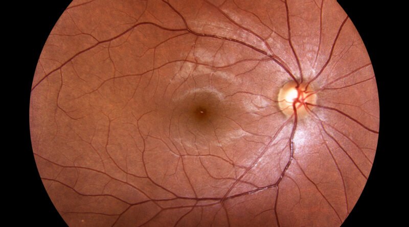 inteligencia artificial y diabetes: imagen médica de una retina